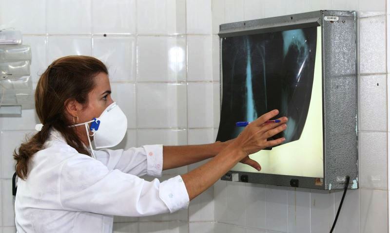 Brasil registra 200 casos de tuberculose por dia