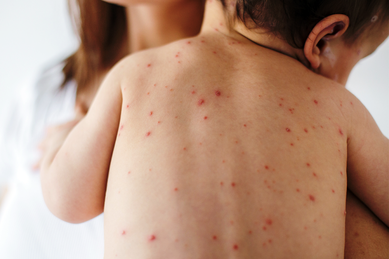 Campanha vacinação contra o sarampo continua até o final de agosto