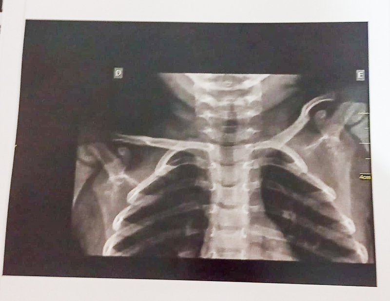 Menina autista de 2 anos quebra a clavícula em creche municipal de